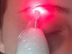 Equipamento de Laser para Micropigmentação