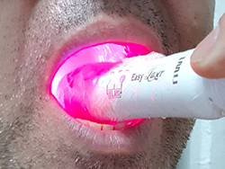 Equipamento de Laser Odontologia